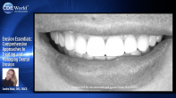 Erosion Essentials: Comprehensive Approaches to Treating and Managing Dental Erosion Webinar Thumbnail